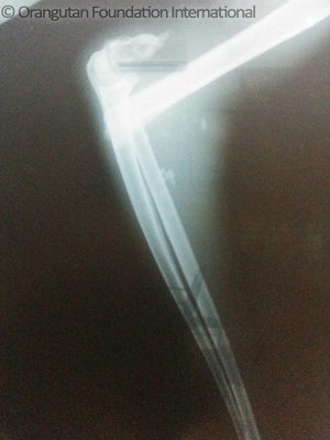 X-Ray of Cempaka Baru's left arm clearly showing a severe fracture